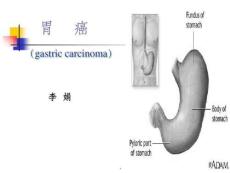 胃癌教学完整