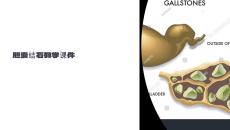 膽囊結石教學課件