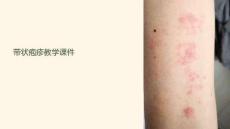 帶狀皰疹教學(xué)課件