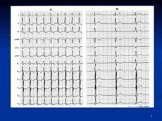 陣發(fā)性室上性心動過速-ppt課件