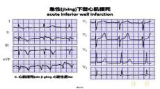 【大學課件資源整合】心電圖最新課件6