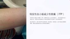 《特发性血小板减少性紫癜》课件