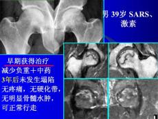 【生物医学】股骨头坏死塌陷的影像临床病理学研究--广州中医药大学2
