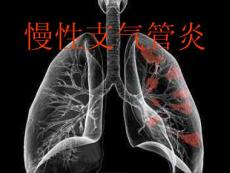 慢性支气管炎3