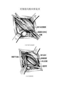 经腹股沟股疝修复术图解