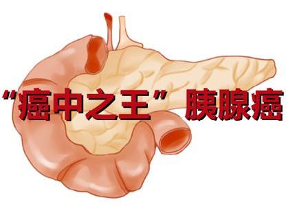 “癌中之王”胰腺癌的病因、診療、護理、預防知識